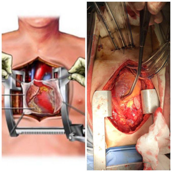 open heart surgery