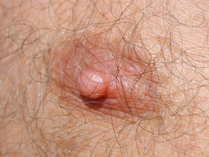 Third (supernumerary) nipple: Types, causes, and removal
