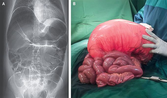 Large-Bowel Obstruction from Hereditary Angioedema