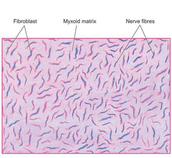 Neurofibroma