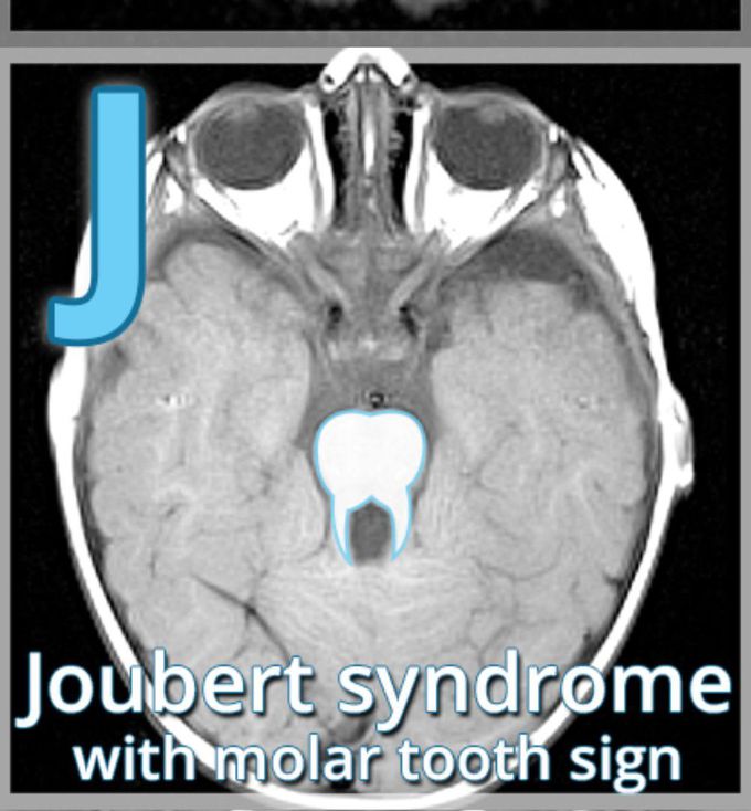 Joubert Syndrome with molar tooth sign