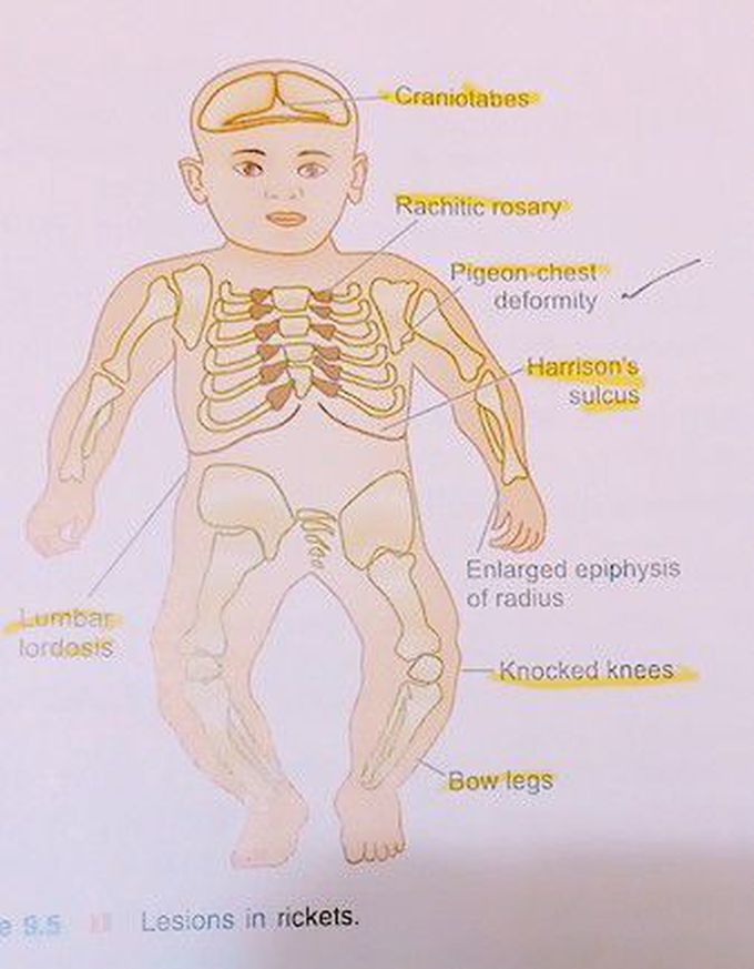 Rickets skeletal changes