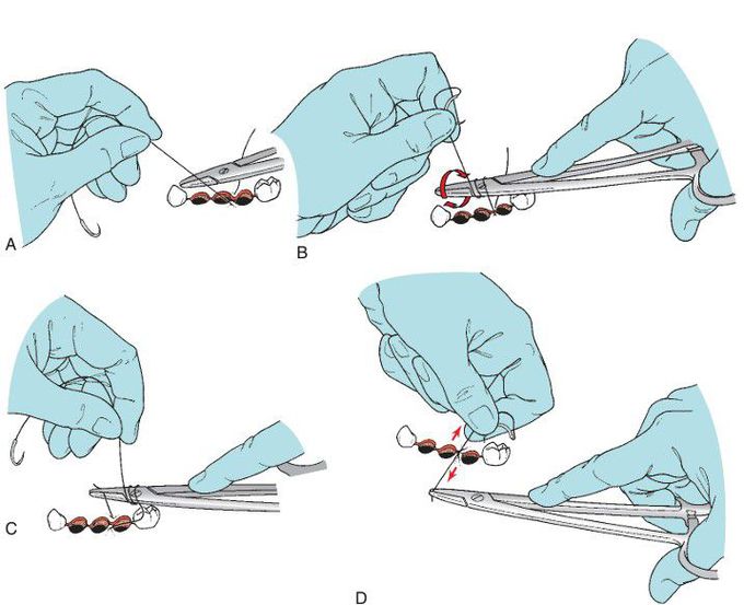 Suture knot