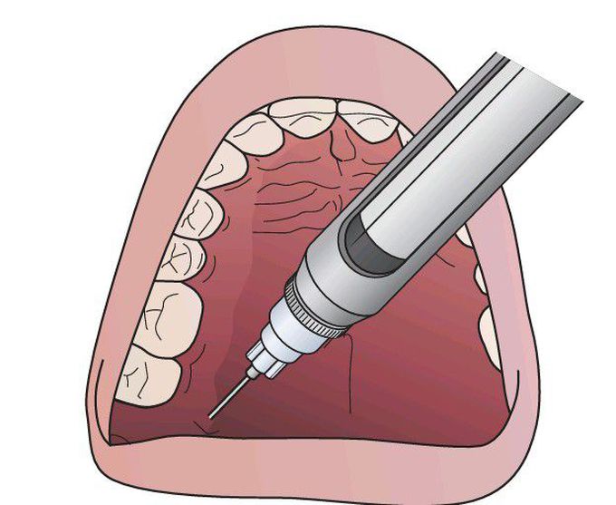 Anesthetizing the greater palatine nerve