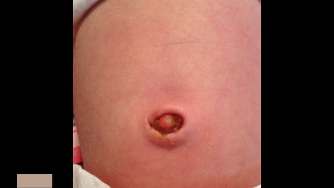 Umbilical granuloma