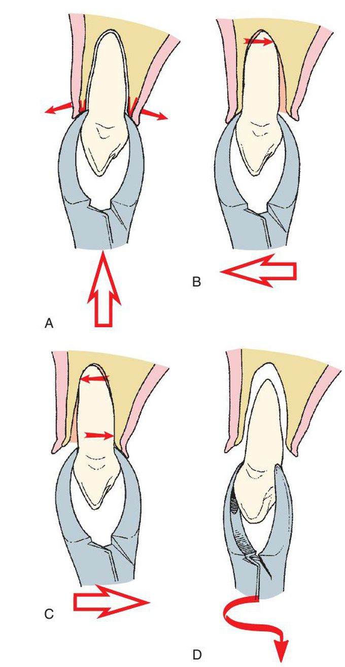 Maxillary canine extraction