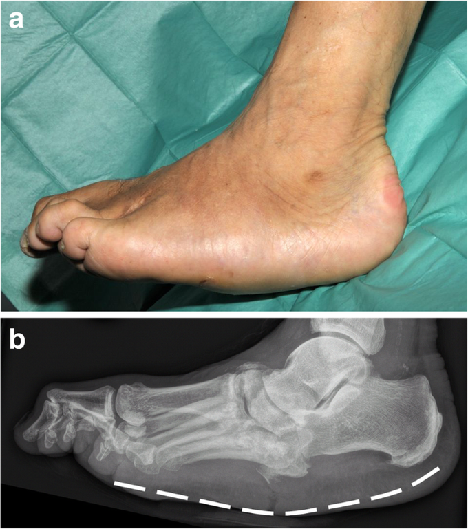 Causes, Presentation, and Management of Charcot Foot