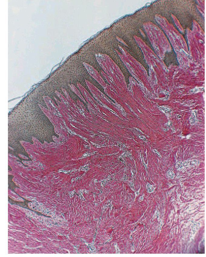 Gingival fibromatosis.
