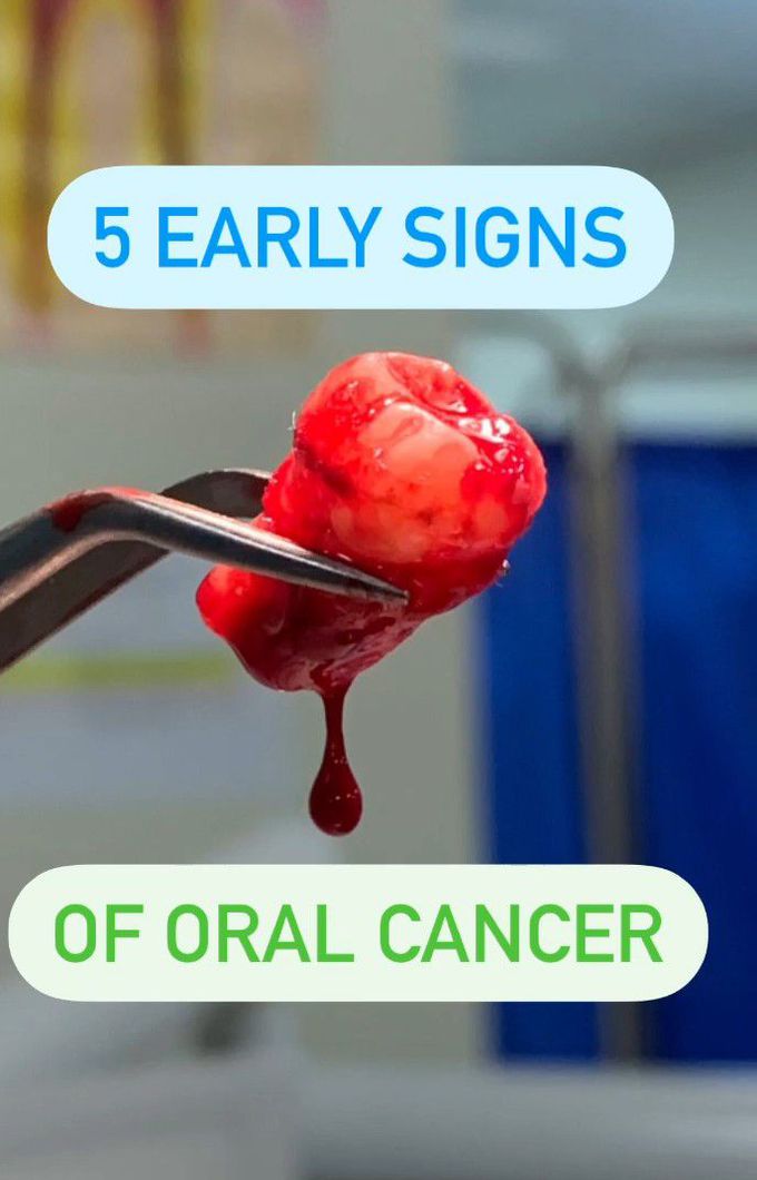 5 Early Signs of Oral Cancer