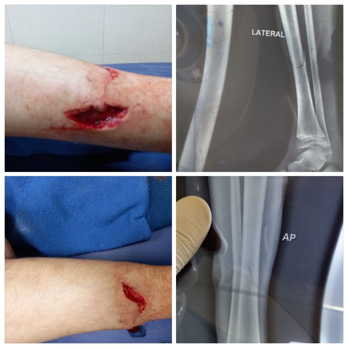 Cp child with bone fracture