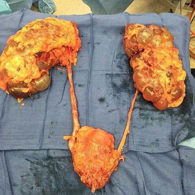 Enbloc Surgical Resection