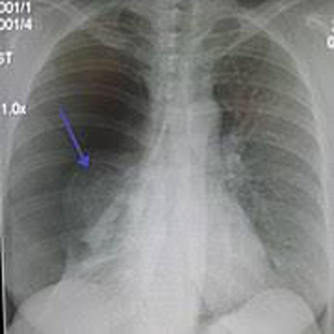 Symptoms of pneumothorax