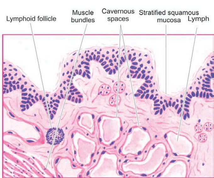 Cavernous lymphangioma of the tongue.