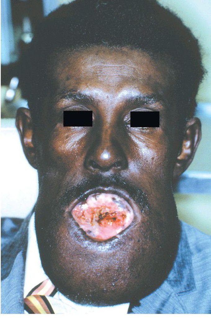 Ameloblastoma