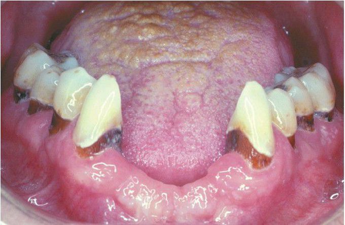 Xerostomia-related Caries.