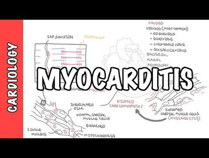 Myocarditis-Pathogenesis