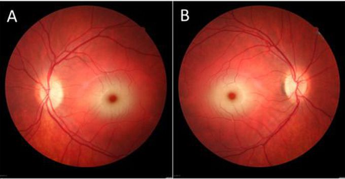 Cause of Cherry-Red Spots at Macula