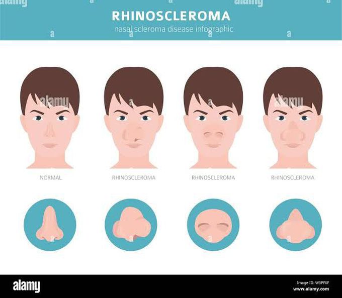 Symptoms of rhinoscleroma
