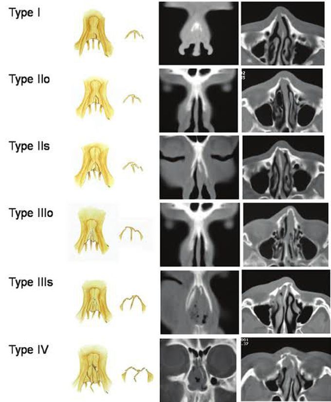 These are the types of nasal fractures