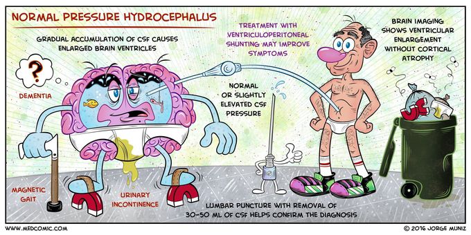 Normal pressure hydrocephalus