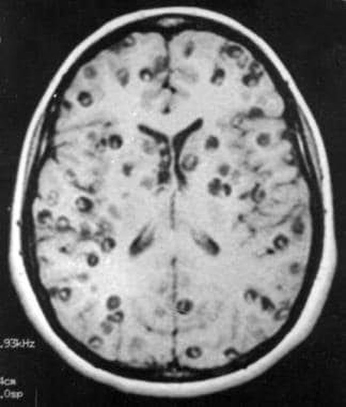 cause of neurocysticercosis