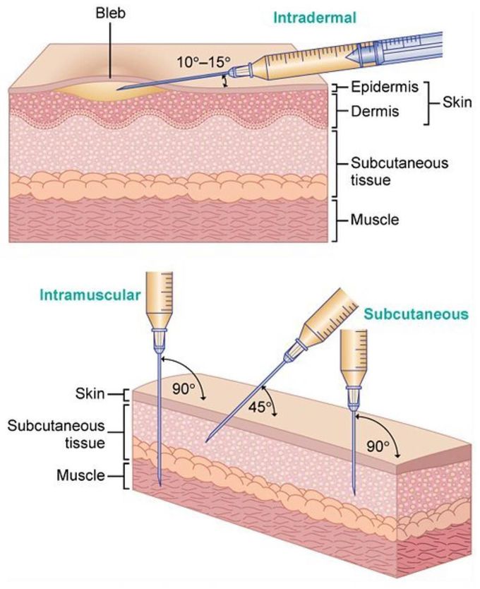 Different types of injections