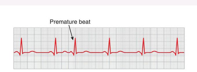 Atrial beat