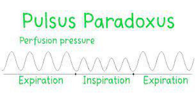 Pulsus paradoxus