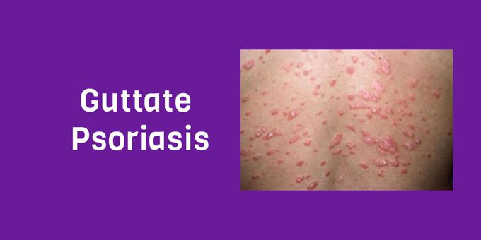 Guttate psoriasis