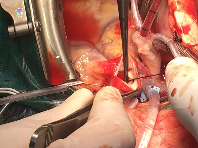 Pediatrics open heart in almakassed hospital 