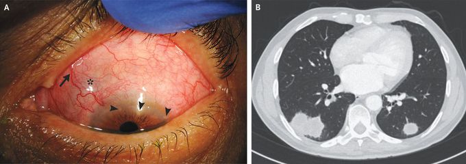 Sclerokeratitis in Granulomatosis with Polyangiitis