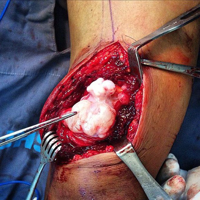 A giant intracranial hydatid cyst