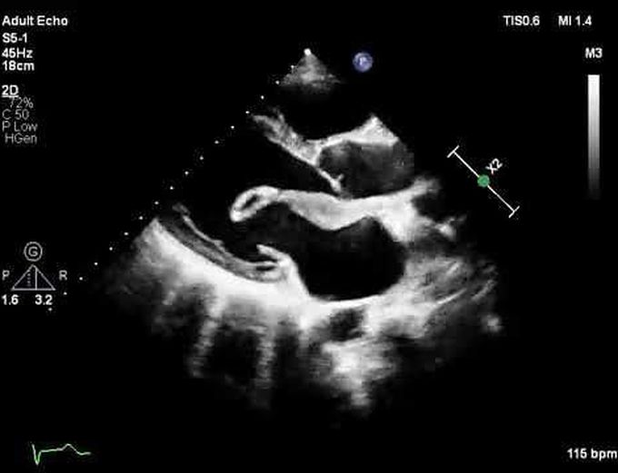 Myxomatous Mitral-Valve Prolapse