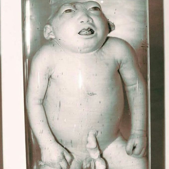 Infant with Anencephaly