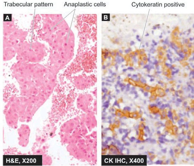 Hepatocellular carcinoma