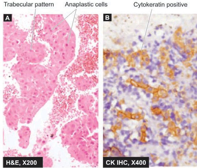 Hepatocellular carcinoma