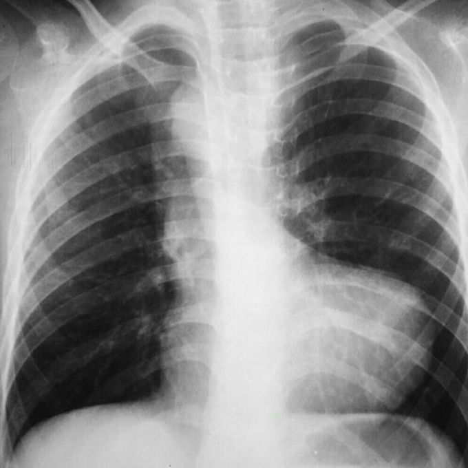 Boot Shaped Heart (Teratology of fallot). TOF is the most common cyanotic congenital heart disorder. It has four cardinal features, Right ventricular hypertrophy, ventricular septal defect, obstriction of right ventricular outflow, and aortic overriding. Plain X-Ray shows boot shaped heart with upturned heart apex. Treatment is by creating a shunt.