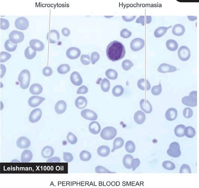 Iron deficiency anaemia