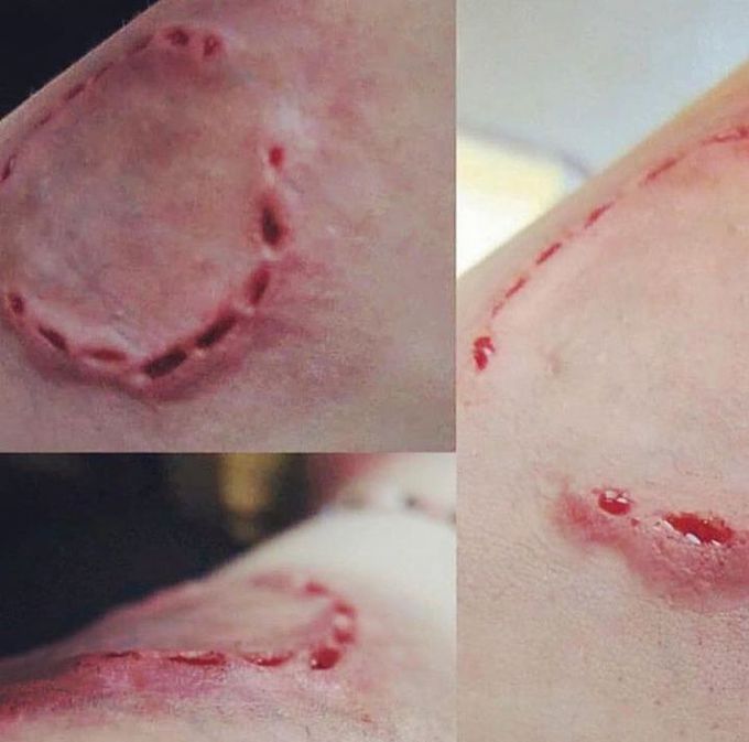 This is what a human bite can do