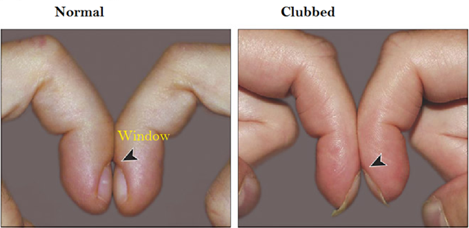 Clubbing test