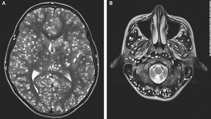 NEUROCYSTICERCOSIS !!!  A case report of a young boy who died of disseminated cysticercosis.