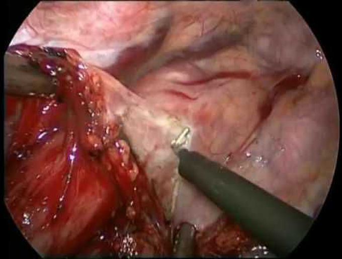 Video 1. VATS mobilisation of the thoracic esophagus.
