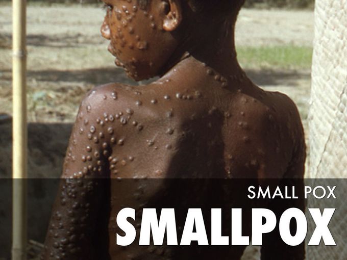 Smallpox