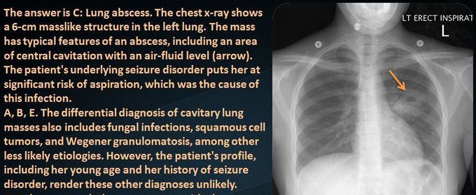 LUNG ABSCESS