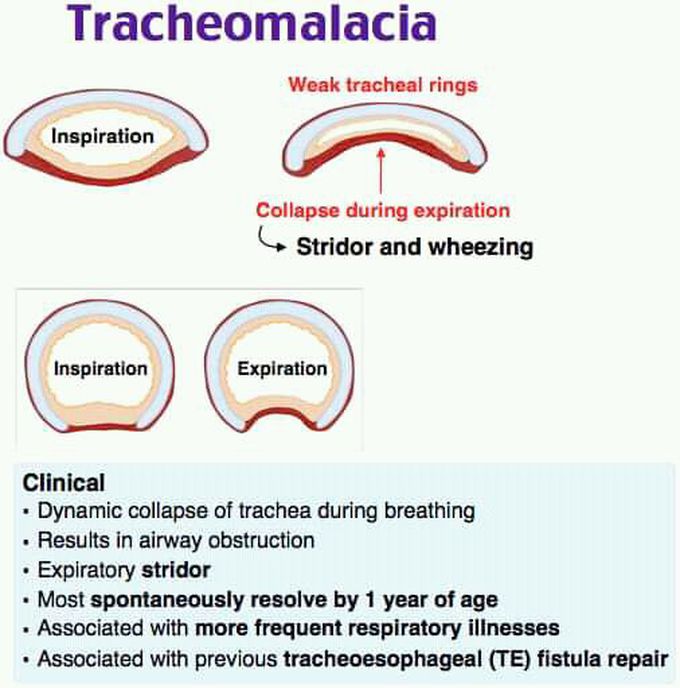 Tracheomalacia