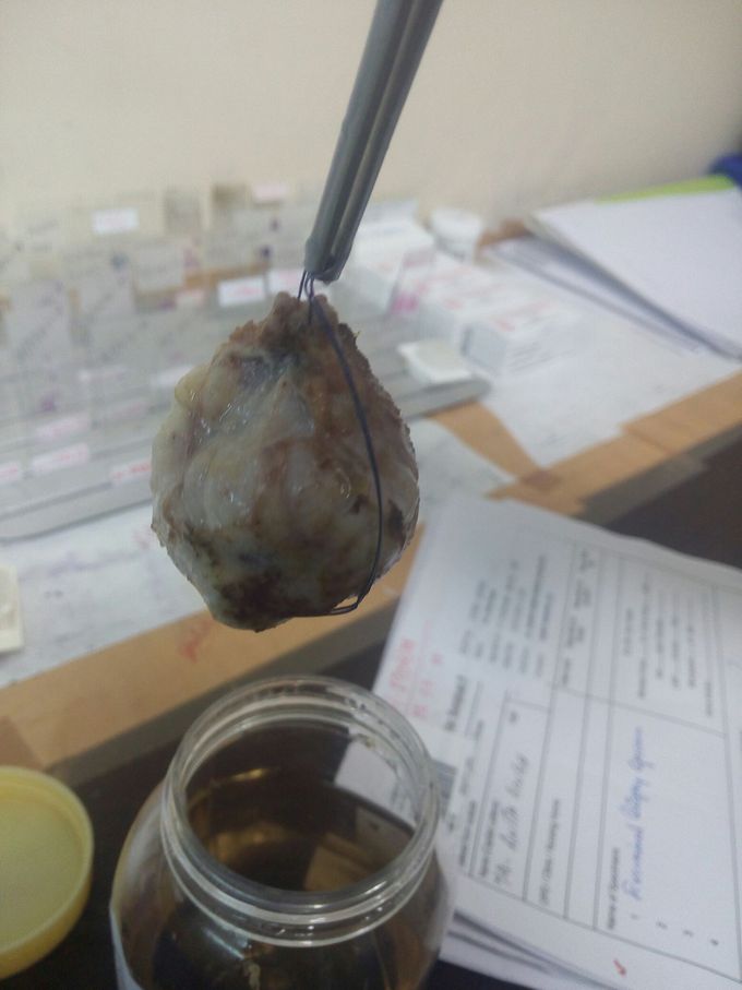 Fibrous adinoma. Commonly called brest tumor