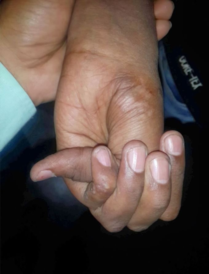 Which sign? In Marfan syndrome.