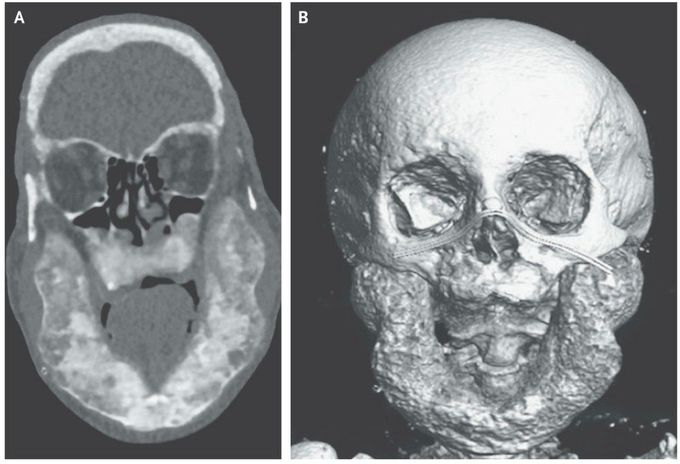 Osteitis Fibrosa Cystica