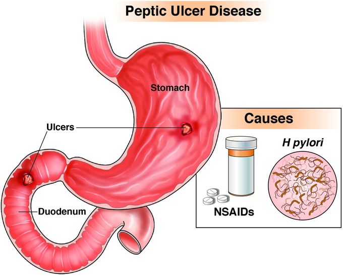 Peptic Ulcer