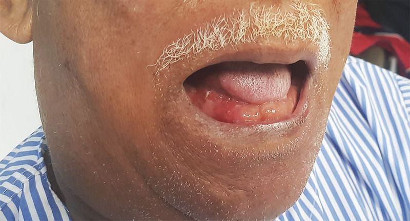 “Double Tongue” Appearance in Ludwig’s Angina